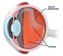 spontaneous detached retina surgery recovery